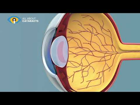 Formation of a cataracts video animation