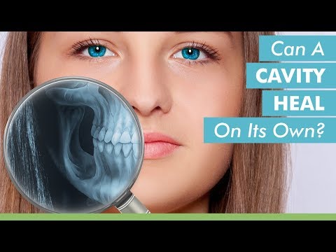 Can A Cavity Heal On Its Own?