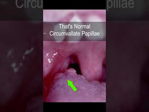 Strange ENT factoids. The “It is abnormal!” But is actually normal circumvallate papillae. #shorts